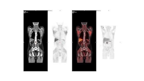 Nuovo radiofarmaco nella medicina nucleare dell’Irccs Crob ...